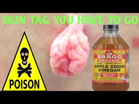 How To Remove A Skin Tag Using Apple Cider Vinegar